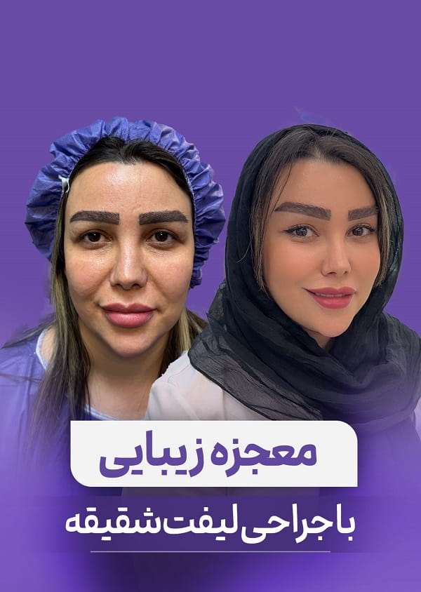 ماندگاری لیفت آندوسکوپیک ابرو؛ از نتیجه اولیه تا سال‌های بعد